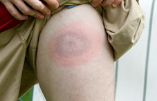 Maladie de la maladie de Lyme sur la jambe d'un jeune homme